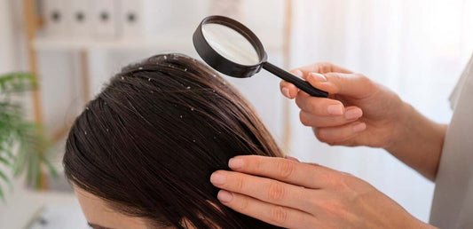 Dandruff 101: Causes and Prevention!